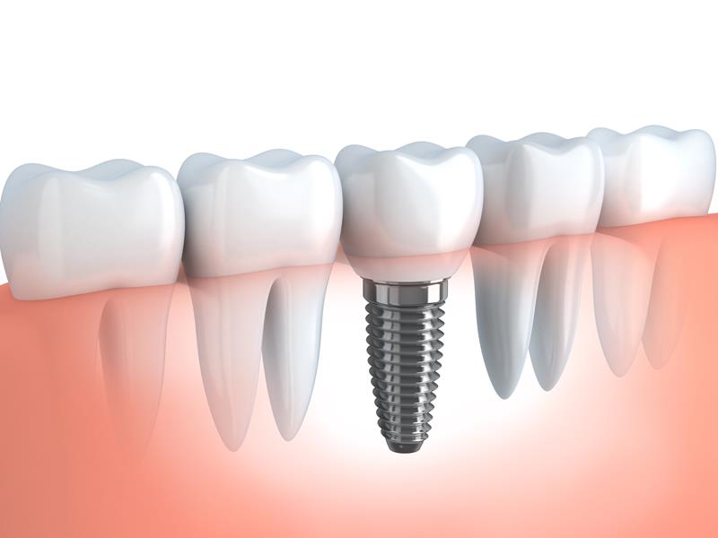 Dental Implants  Sacramento, CA 